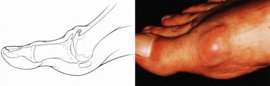 Hallux rigidus - Die Arthrose des Grosszehengrundgelenkes